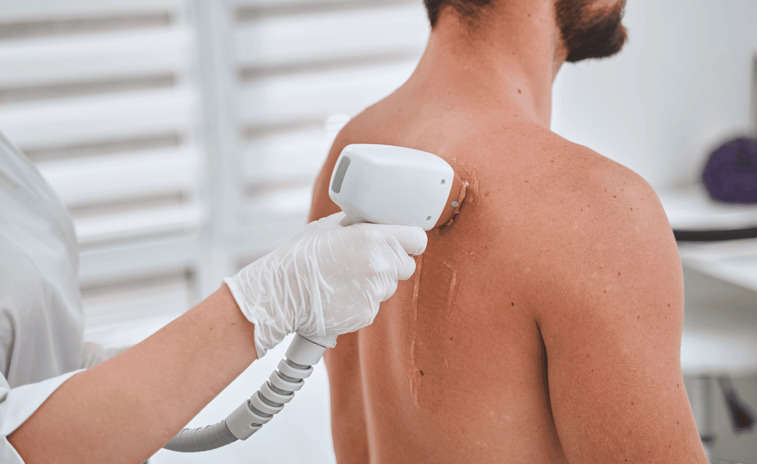 Hair Removal for Men